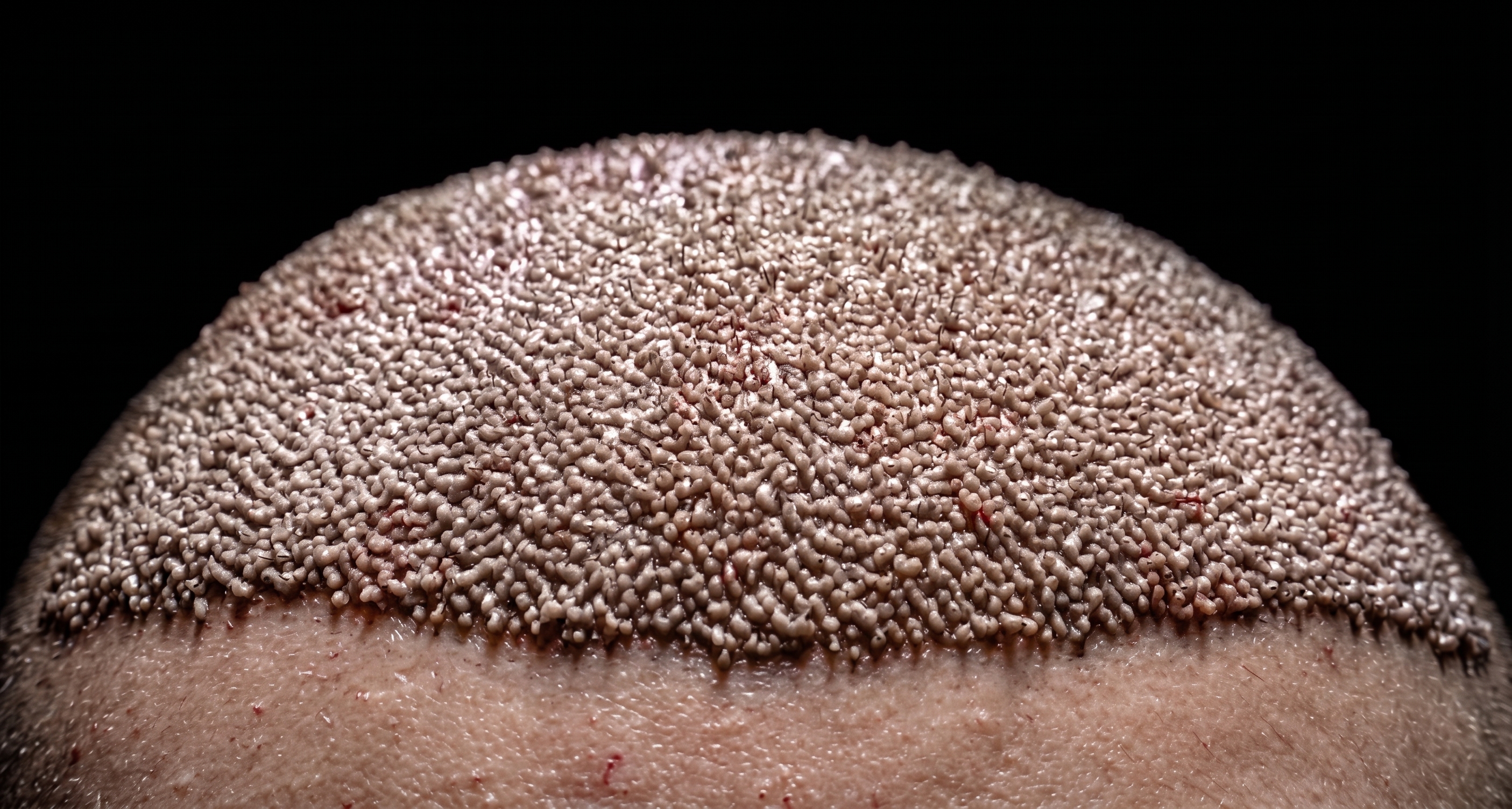 Hakan Güner Hair Transplant Clinic saç ekimi öncesi greft hazırlığı